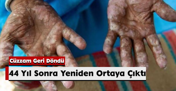 44 Yıl Sonra Yeniden Ortaya Çıktı: Cüzzam Geri Döndü
